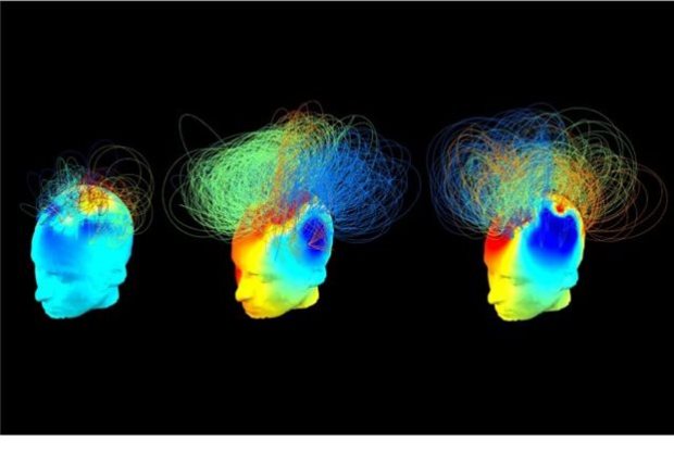 Αριστερά και στο μέσο της εικόνας απεικονίζονται τα εγκεφαλικά δίκτυα δύο ασθενών που βρίσκονται σε κατάσταση «φυτού» ενώ ο τρίο δεξιά στην εικόνα είναι το εγκεφαλικό δίκτυο ενός υγιούς ατόμου. Το δίκτυο του πρώτυ ασθενούς δείχνει μια μικρή δραστηριότητα ενώ του δεύτερου παρόμοια με εκείνη του υγιούς ατόμου. Credit: (Srivas Chennu)