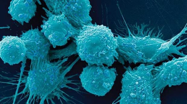 Η αναστολή της δράσης του μορίου SRPK1 που τροφοδοτεί τους όγκους εκτιμάται ότι θα οδηγήσει σε αποτελεσματικές θεραπείες ενάντια στον καρκίνο του προστάτη (στην εικόνα καρκινικά κύτταρα του προστάτη) αλλά και άλλες μορφές της νόσου 
