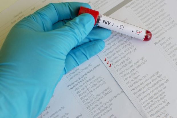 bigstock-Epstein-Barr-virus-EBV-blood-105444212
