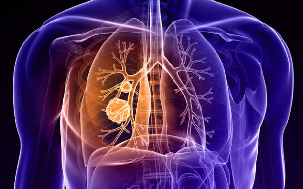 lung-cancer-640x399
