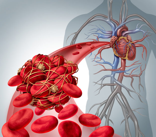 Blood clot risk and clot or thrombosis medical illustration symbol as a group of human blood cells clumped together by sticky platelets and fibrin creating a blockage in an artery or vein leading to the heart.